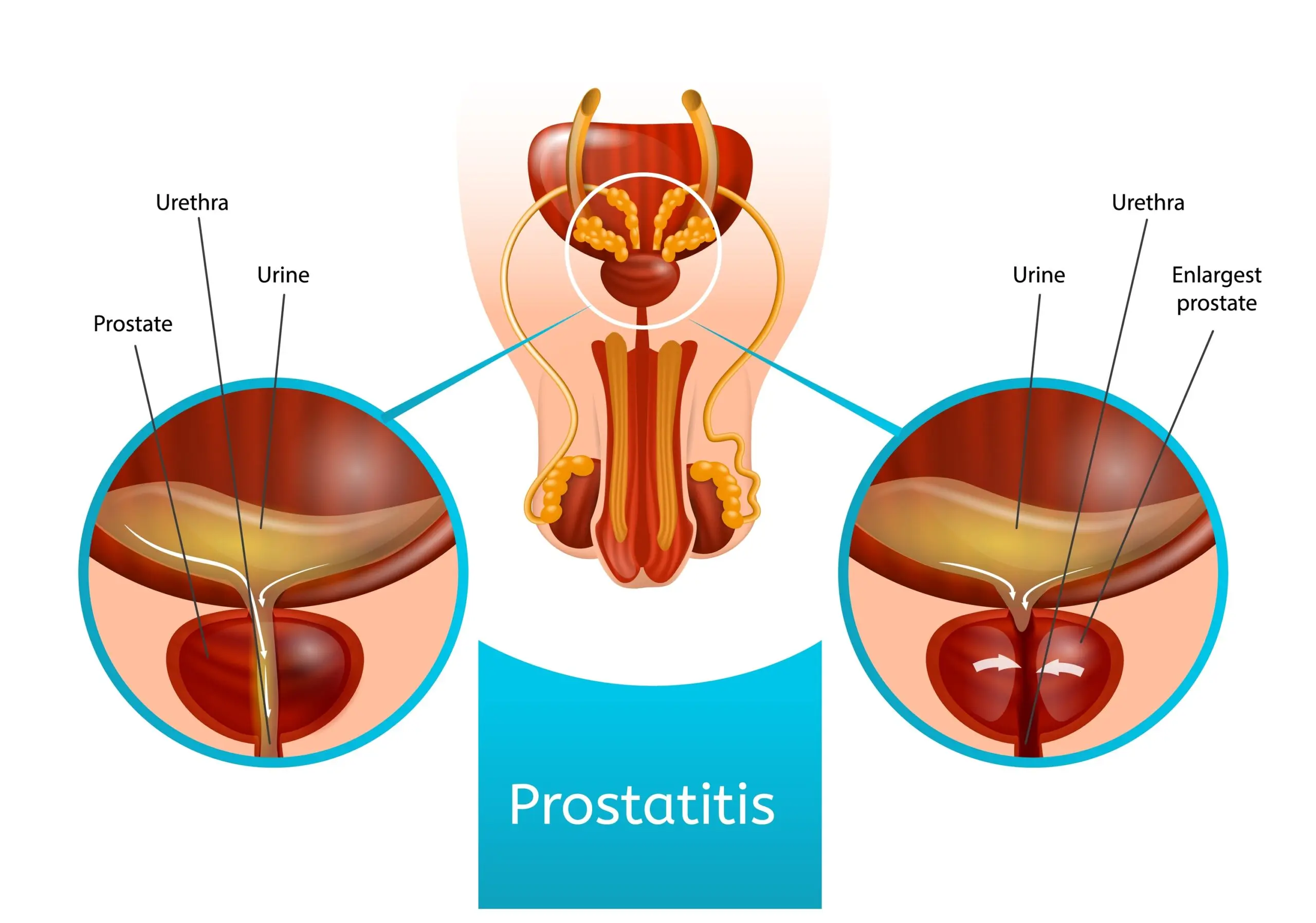 Prostatitis Prof Federico Guercini